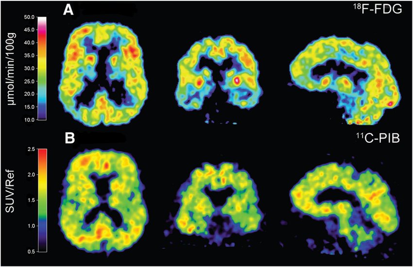 A Common Fitness Supplement May Show Promise Against Alzheimer’s 3 Brain PET scan comparison showing reduced glucose metabolism in Alzheimer’s patients