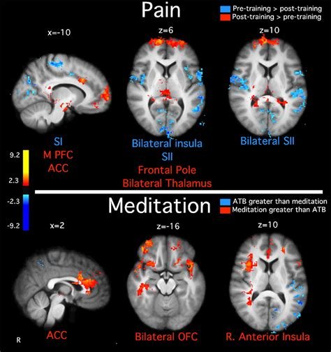 Functional Brain Changes in Meditation vs Pain Study