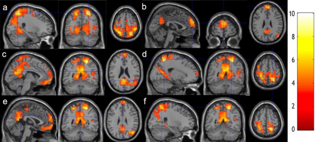 MRI Brain Activity After Meditation Training