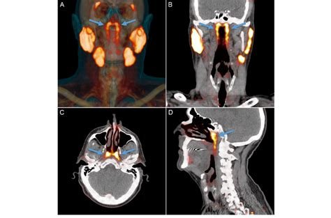 PSMA PET or CT Visualization of Tubarial Glands